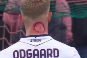 九游体育官网-被僵尸咬了？奥德加德脖子现恐怖红斑，赛后回应是脖子用的药